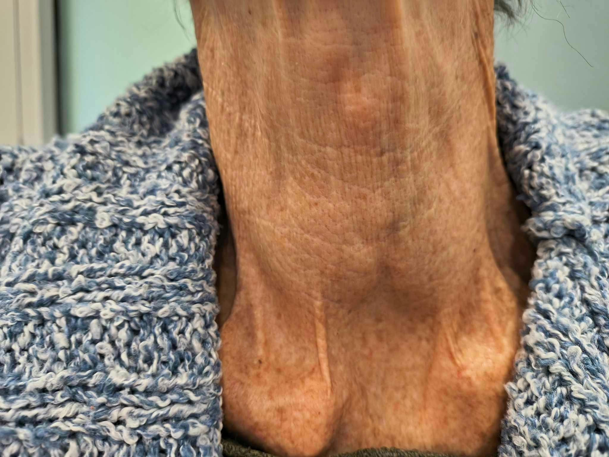 Pitting oedema to the umbilicus