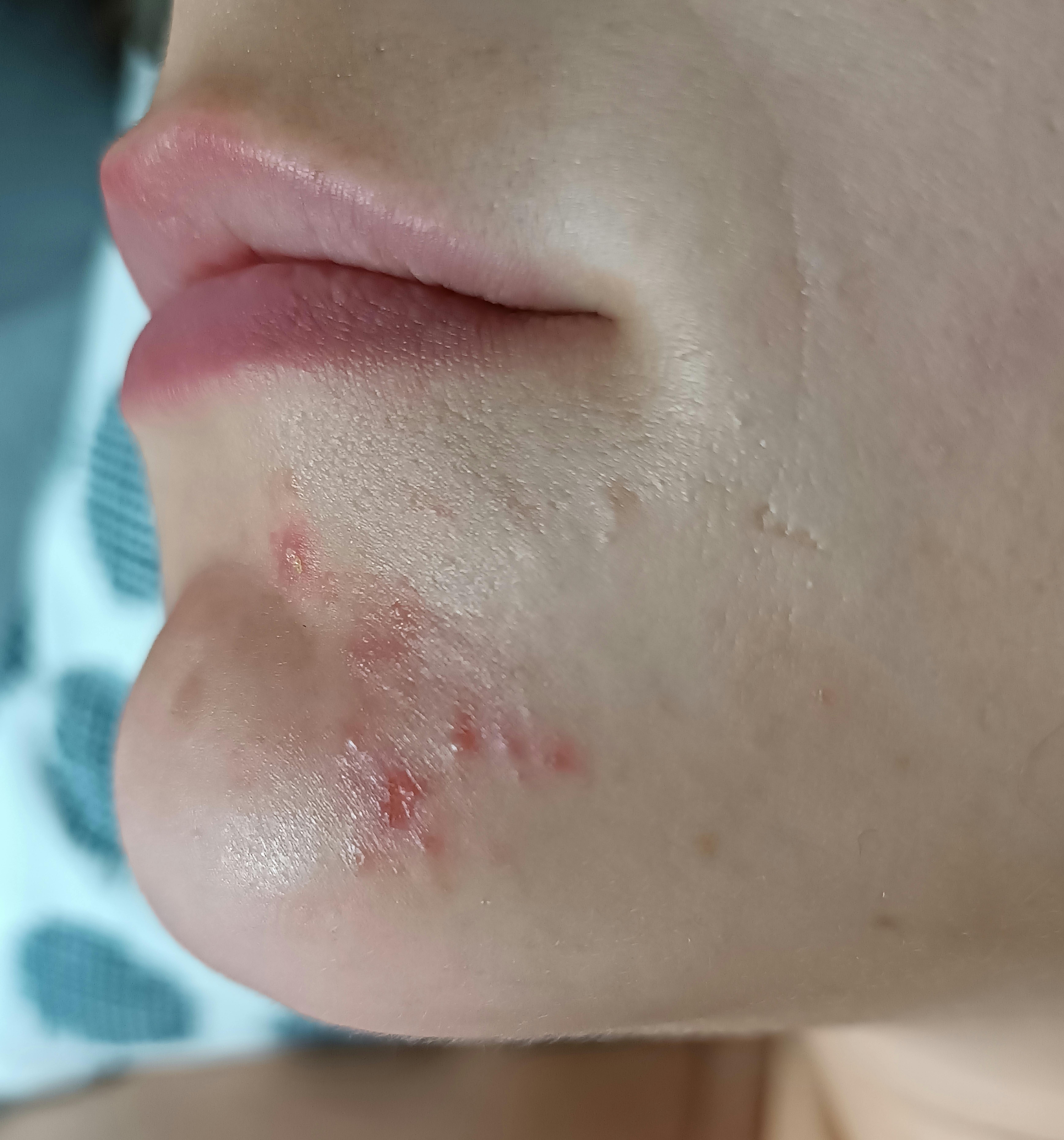 Derm Immuno Today - Dermatology Immunotherapy News | Docwire News