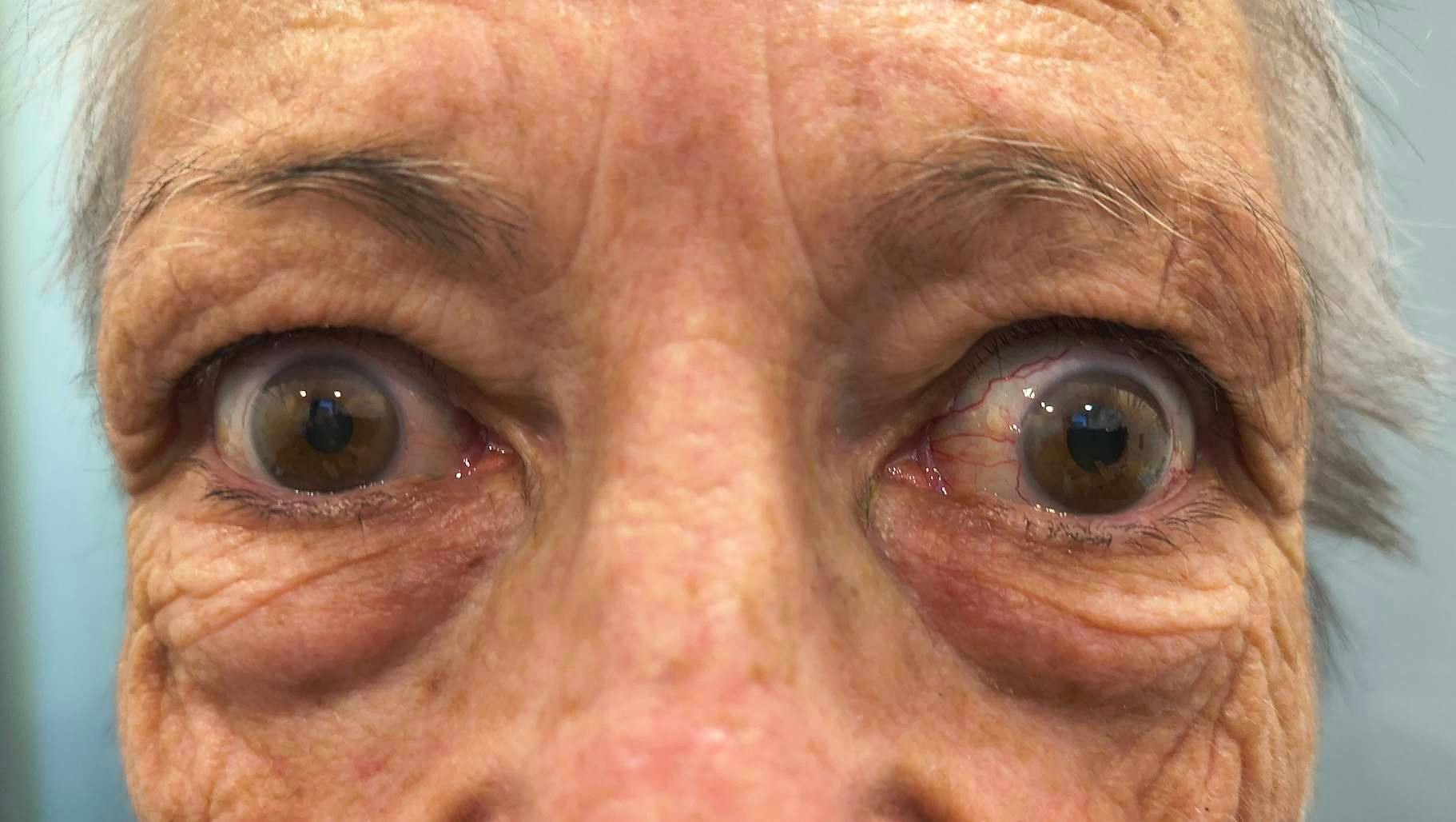 Pitting oedema to the umbilicus