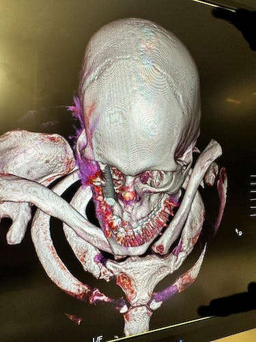 Slipped and fell backwards